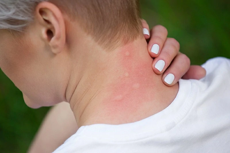 Mik a szúnyogcsípés allergia tünetei?